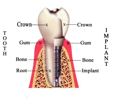 Dental Implants