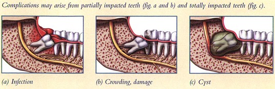 ImpactedWisdomTeeth